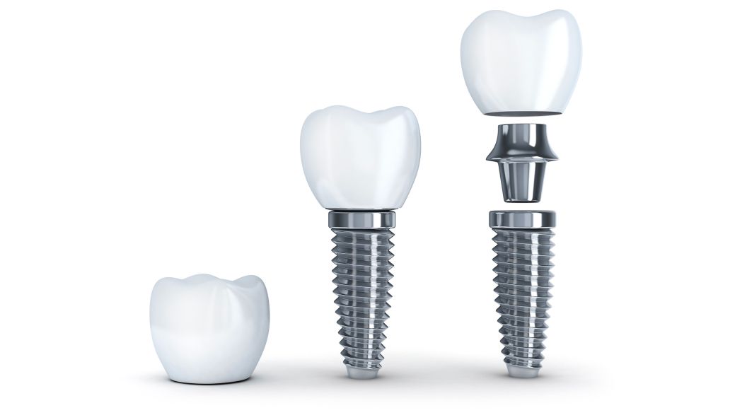 Dental Implant